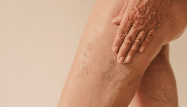 can-you-reverse-crepey-skin?-look-for-these-ingredients