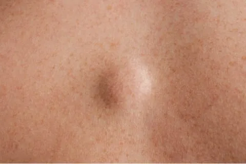 lipoma lipoma