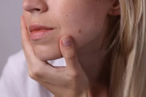 woman with moles woman with moles