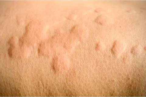 hives hives
