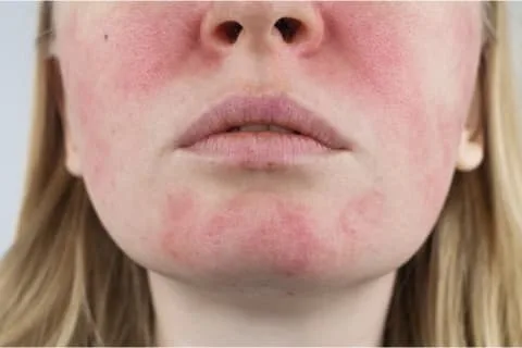 woman with rosacea woman with rosacea