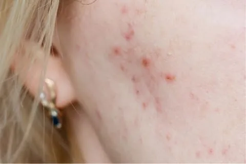 woman with acne on sheeks woman with acne on sheeks