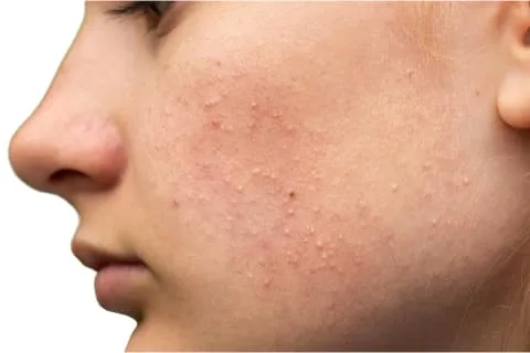 woman with small bumps on her face woman with small bumps on her face
