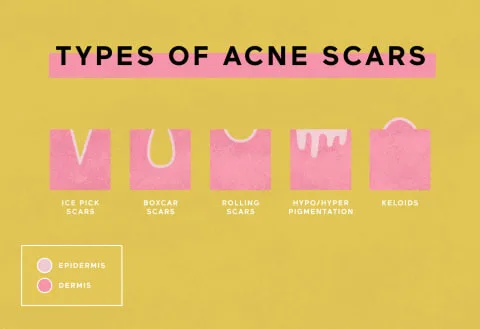 types of acne scars graphic types of acne scars graphic