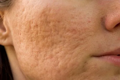 woman with acne scars woman with acne scars