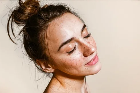 Do you have Freckles, Melasma, or Dark spots? Tips to Identifying Each Do you have Freckles, Melasma, or Dark spots? Tips to Identifying Each